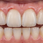 Whitening strip application with gum irritation